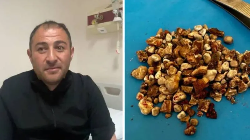 300 Böbrek Taşı Şoku! "Hatırası Var" Deyip Ne Yaptı?