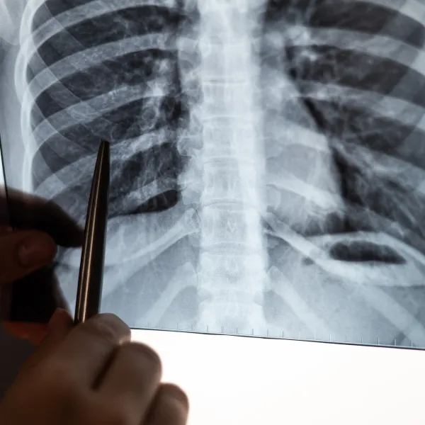 KOAH Alarmı: 40 Yaş Üstü Her 4 Kişiden 1'i Risk Altında!