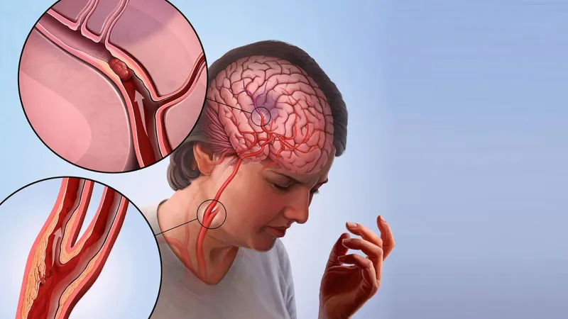 İnme Kader Değil! Türk Doktorlardan Şok Uyarı: %80 Önlemek Mümkün!
